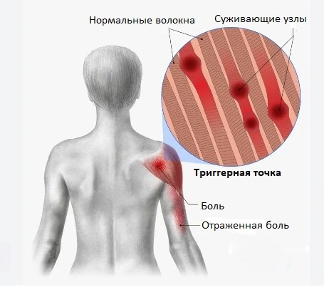 Заболевания мышц, которые вызывают боли посередине спины
