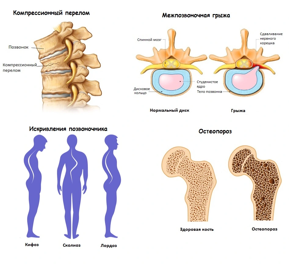 Патологии позвоночника и костей, вызывающие боли в спине в области лопаток