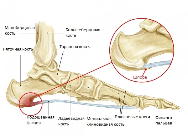 Пяточная шпора - причина боли в пятке