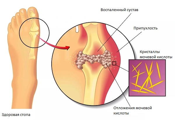 Подагра - причина почему болит пятка сзади