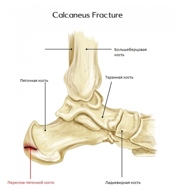 Перелом пяточной кости: симптомы, причины, диагностика и методы лечения в «СМ-Клиника»