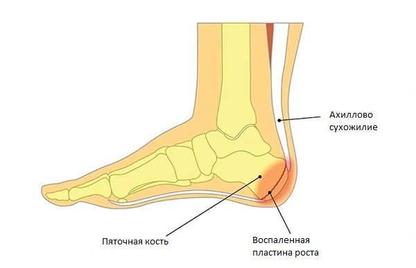 Синдром Севера - причина болей в пятке при ходьбе и наступании у детей