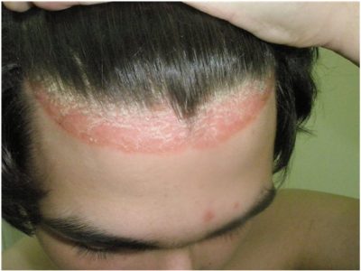 Болячки на коже головы: лечение