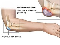 Причины локтевого бурсита 