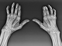 Причины артроза кистей рук