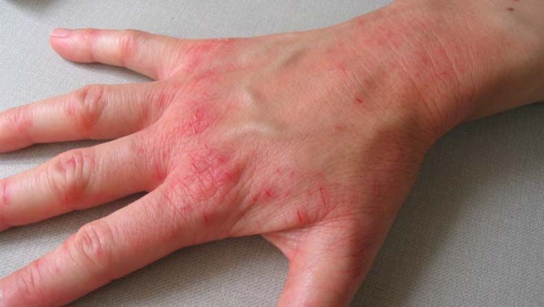 Псориаз — хроническая и очень опасная болезнь кожи