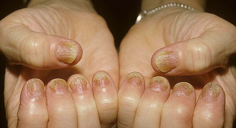 Точечные кровоизлияния под ногтями при псориазе