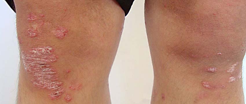 Лечение псориаза на локтях и коленях в Москве | Клиника АЛОДЕРМ Москва