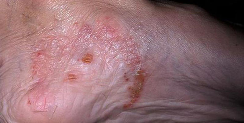 eczema varicoza picior)