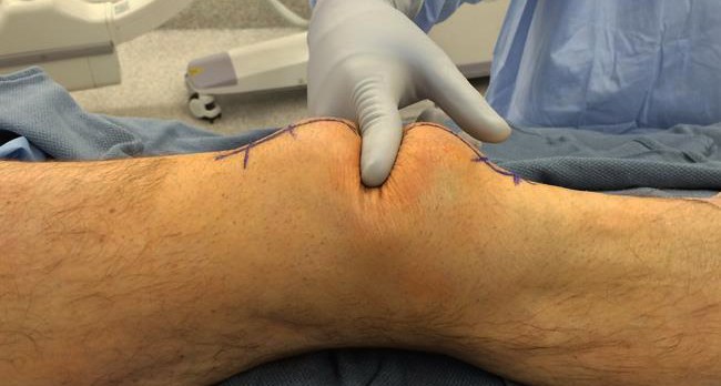 Лечение воспаления синовиальной оболочки коленного сустава