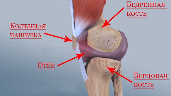 Пункция коленного сустава