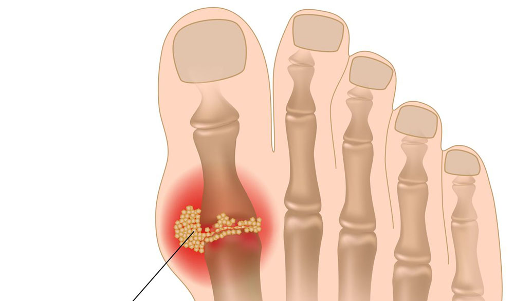 Подагра: причины, симптомы и лечение подагры в Москве в ФНКЦ ФМБА