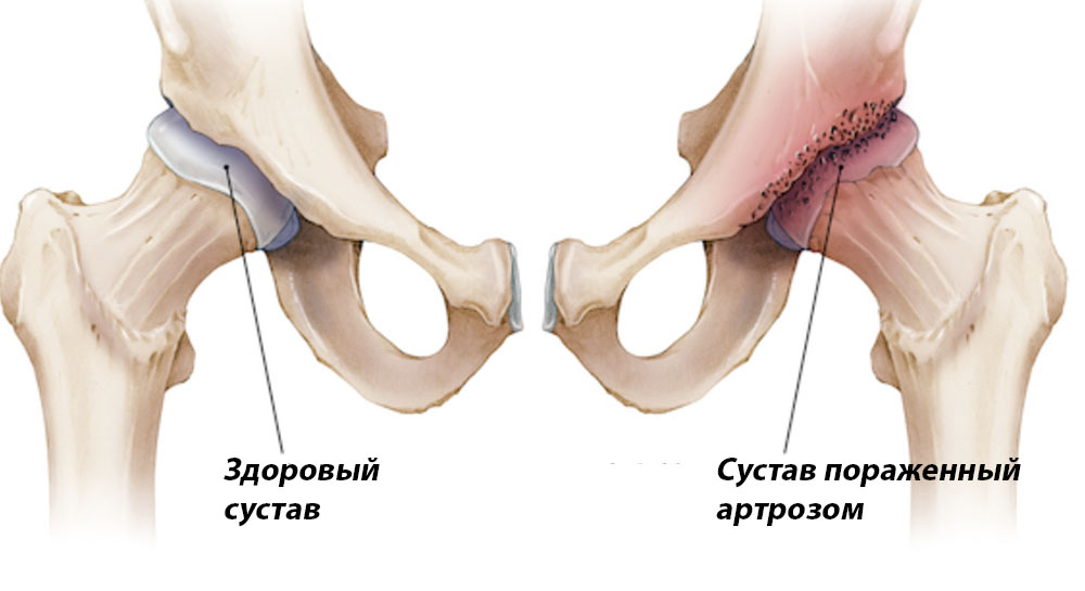 Изменения суставного хряща при коксите