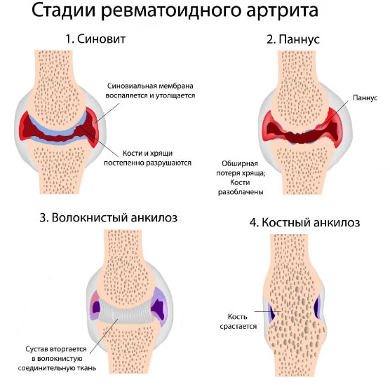 Стадии заболевания