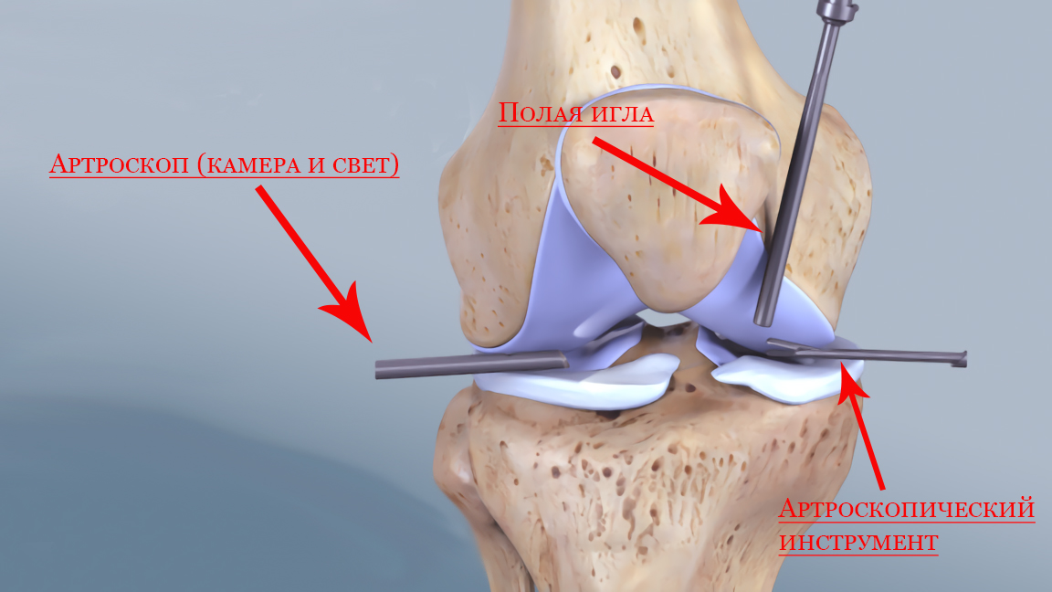 Как укрепить коленные суставы? Советы эксперта и упражнения для укрепления коленей