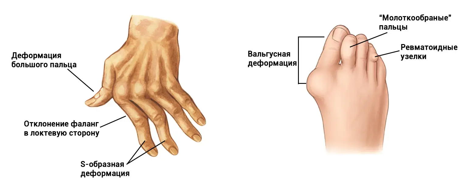 Деформации кисти и пальцев стопы у женщин при ревматоидном артрите