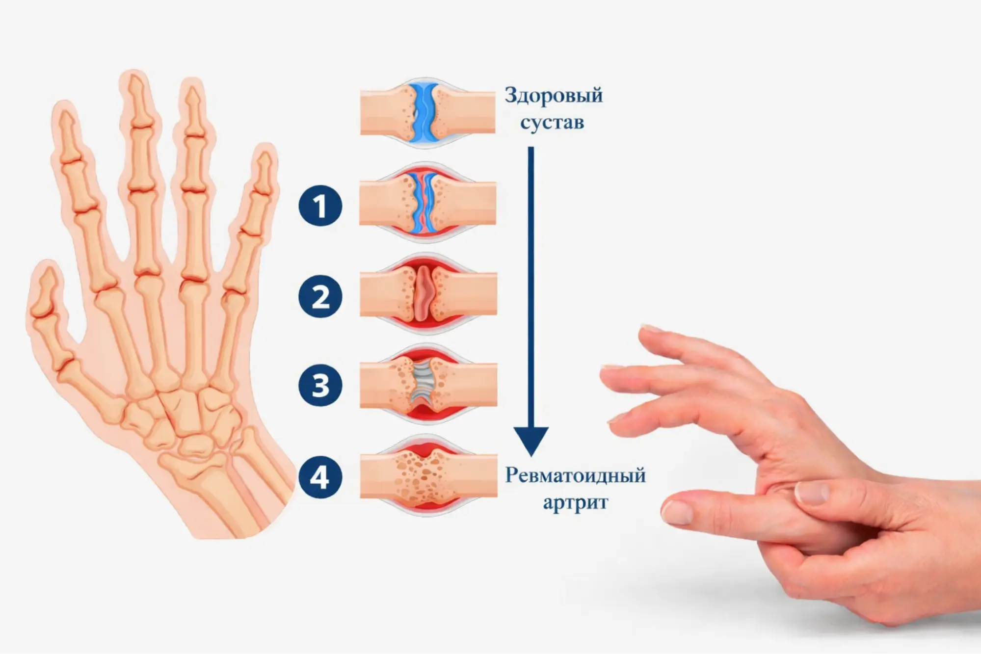 Последовательные внутрисуставные изменения при ревматоидном артрите