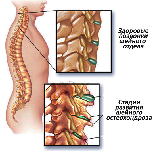 Симптомы остеохондроза шейного отдела