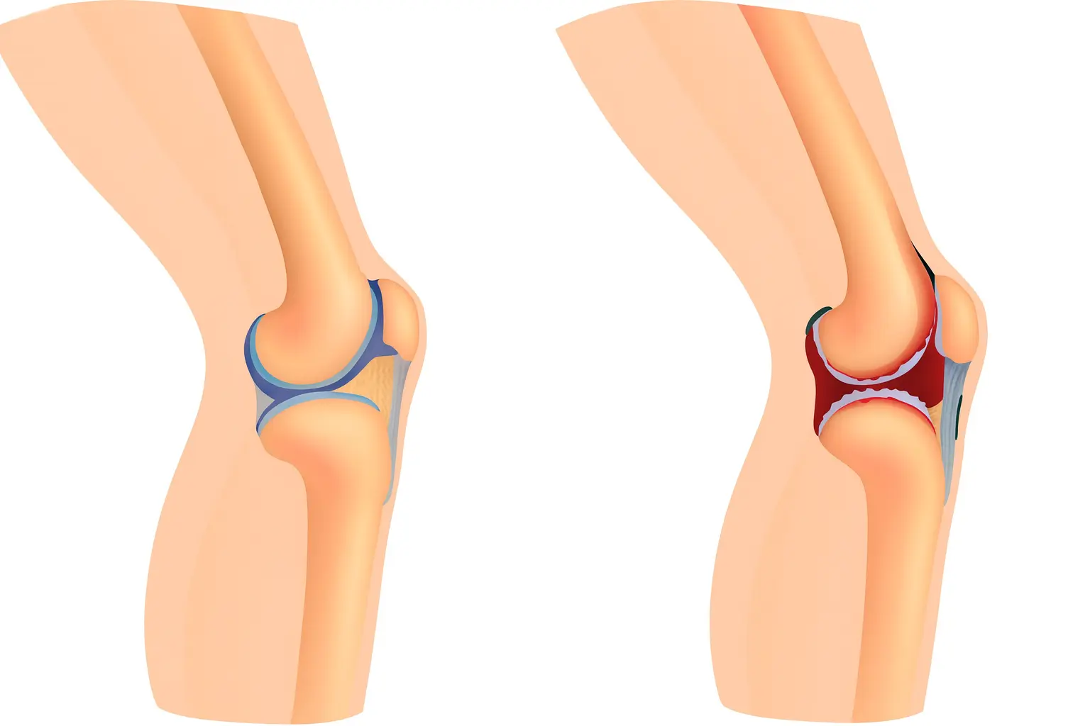 Здоровый коленный сустав и сустав при ревматоидном артрите