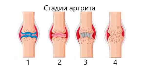 Стадии артрита