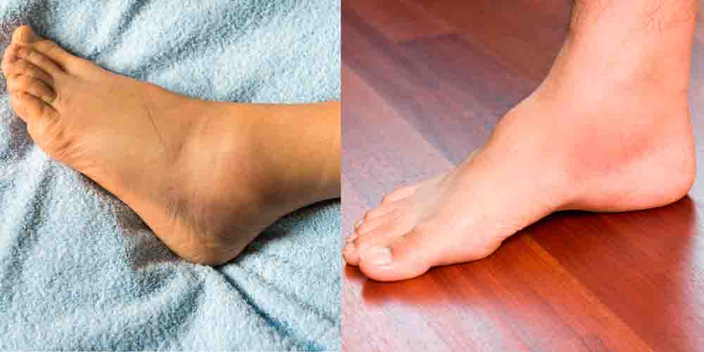Ревматоидный артрит суставов стопы и голеностопа