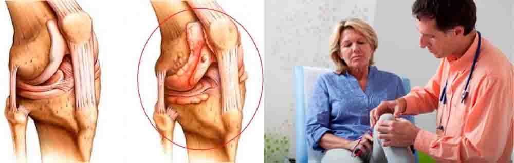 Острый гнойный артрит коленного сустава