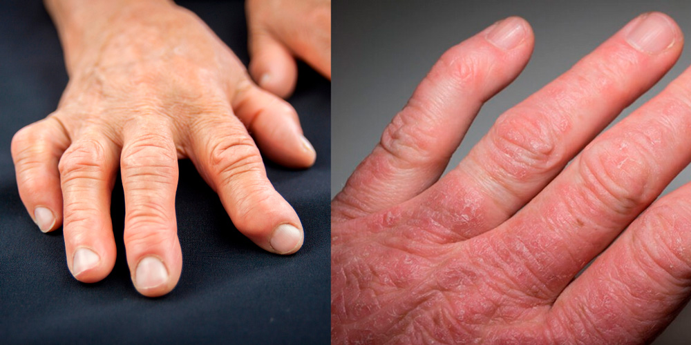 Ревматоидный и псориатический артрит рук