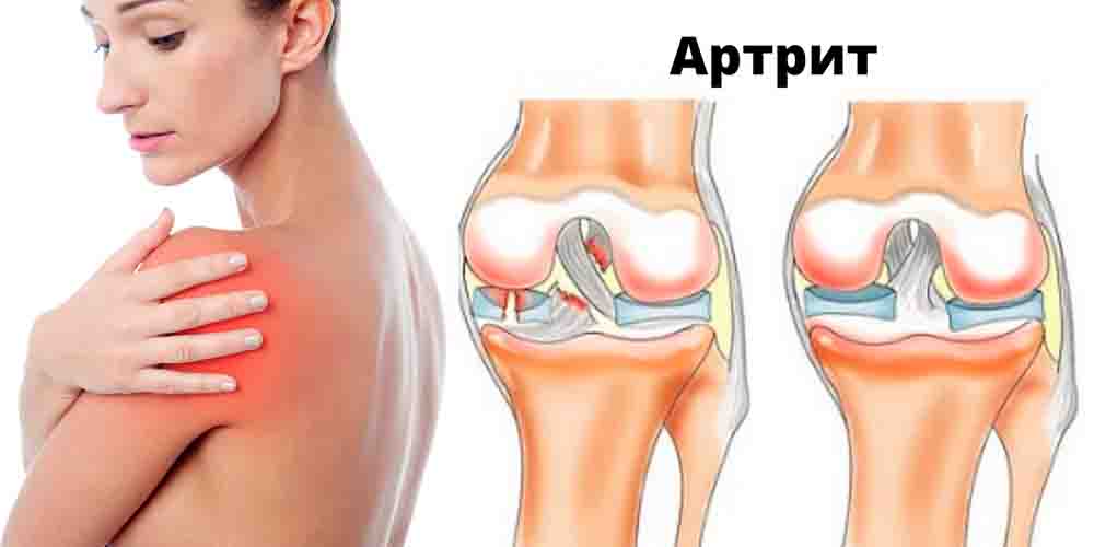 Симптомы плечевого артрита