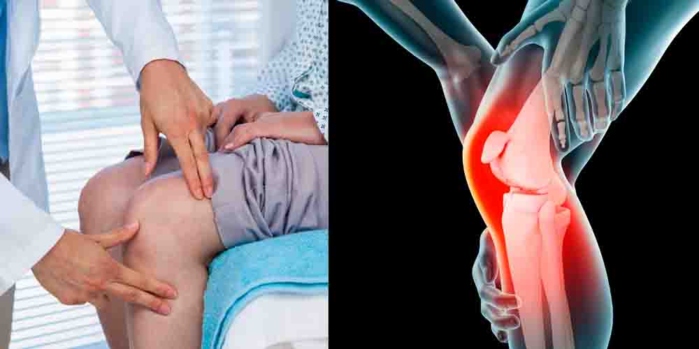 Симптомы артроза коленного сустава