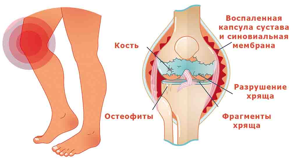 Деформирующий артроз колена
