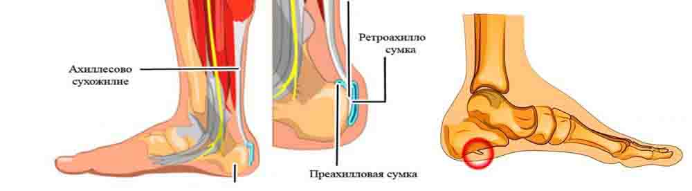 Бурсы в области ахиллова сухожилия и пяточная шпора