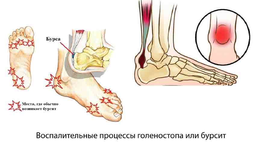 Воспалительные процессы голеностопа