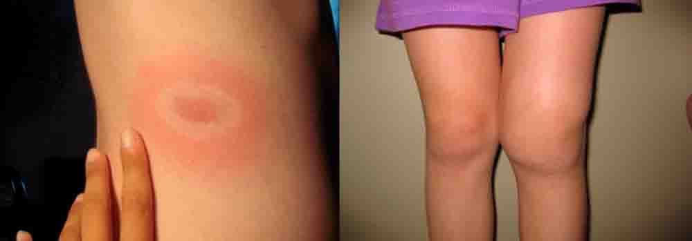 Инфекционный артрит коленного сустава