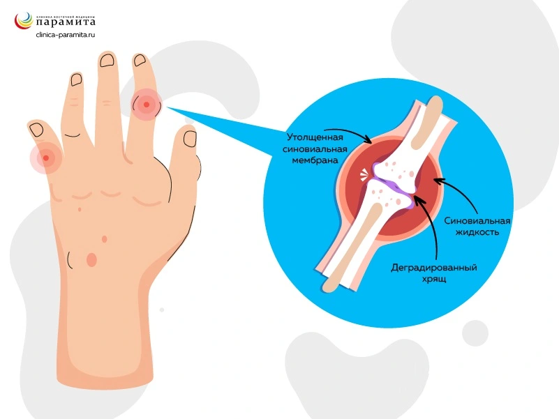 Ревматоидный и псориатический артрит рук