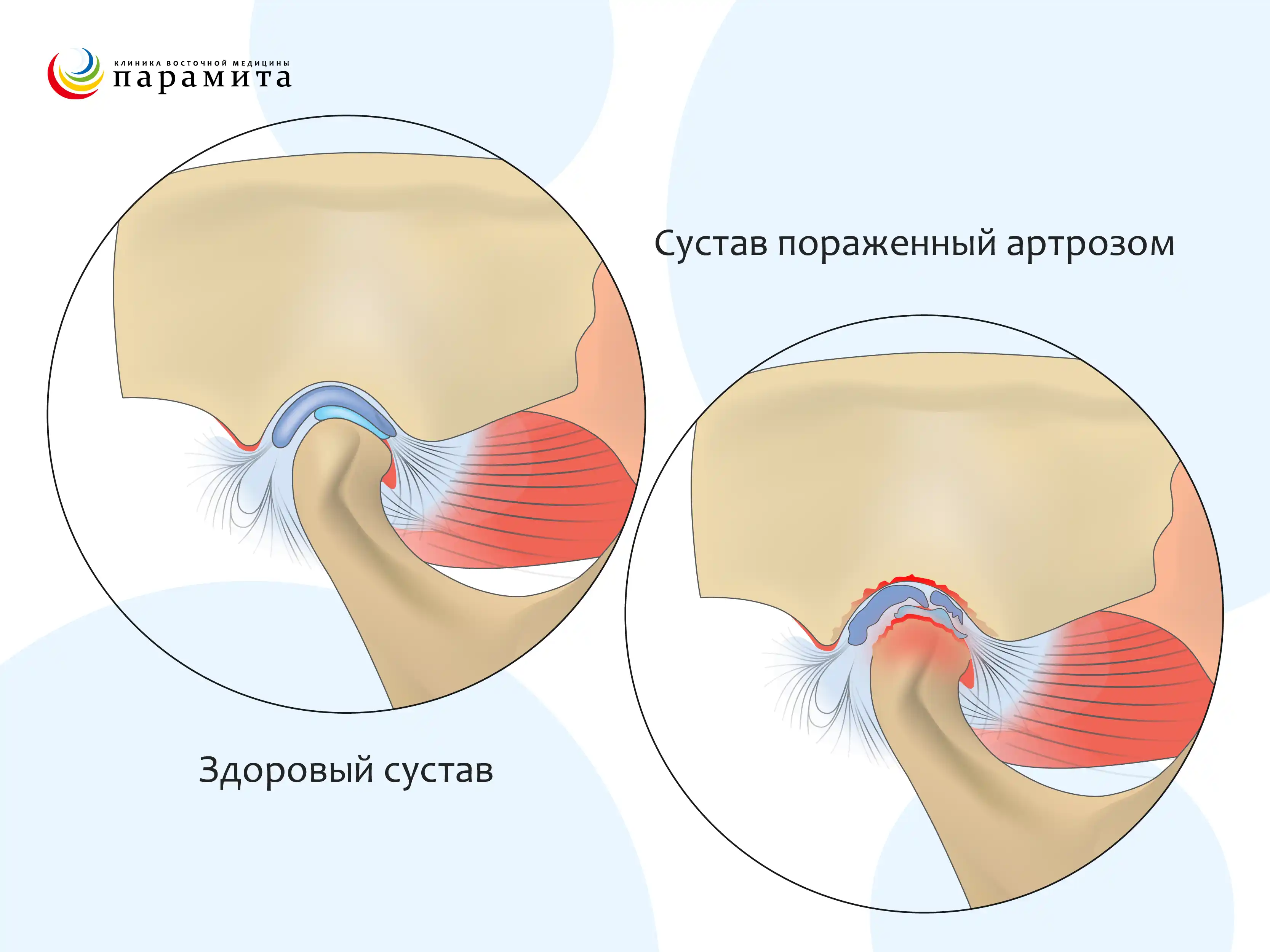 Поражение височно-нижнечелюстного сустава артрозом