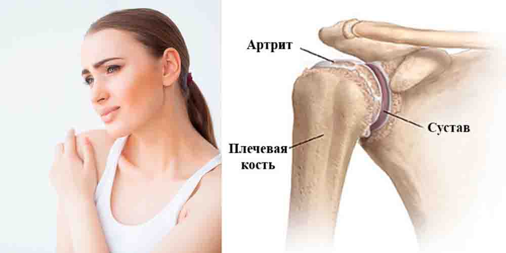 Посттравматический артрит плечевого сустава