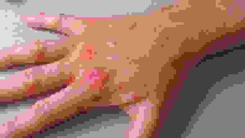 Экссудативная форма псориаза на кистях рук - поражения на пальцах