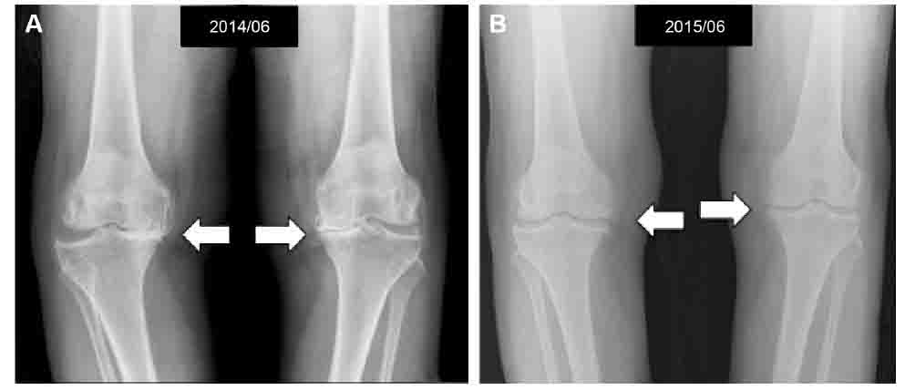 Результат PRP-терапии коленного сусава