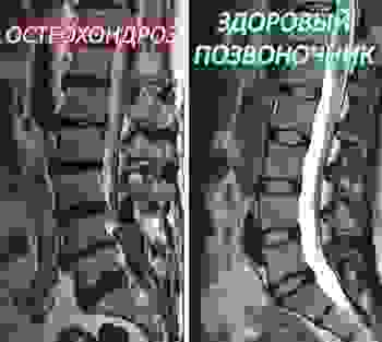 Поражение межпозвоночных дисков поясничного отдела при остеохондрозе
