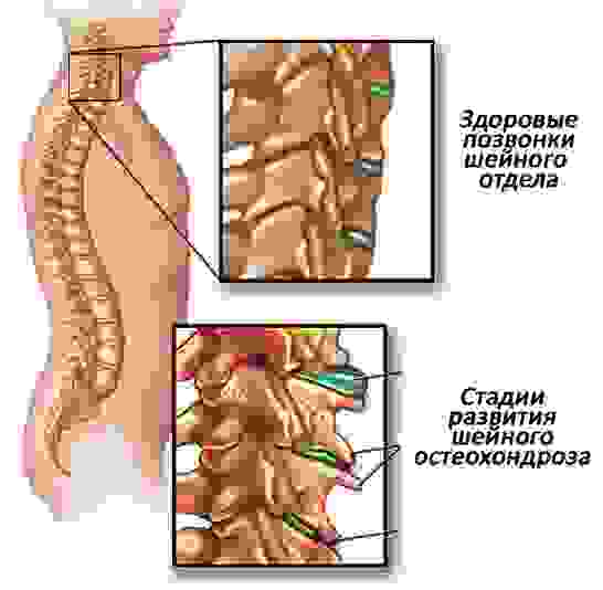 Деформация шейных позвонков при остеохондрозе