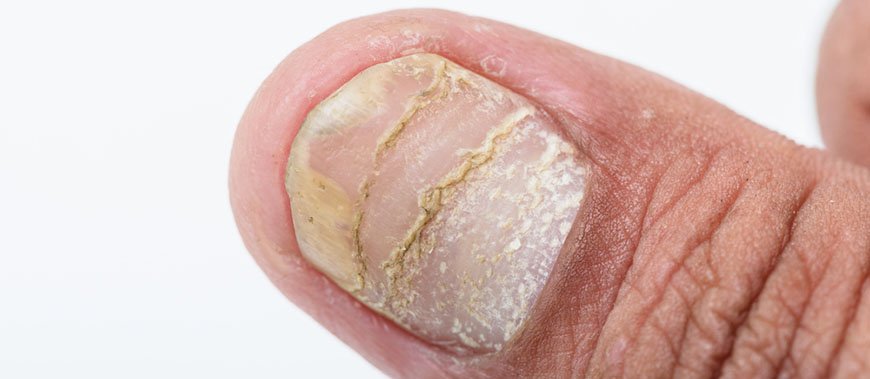 Острая форма ногтевого псориаза