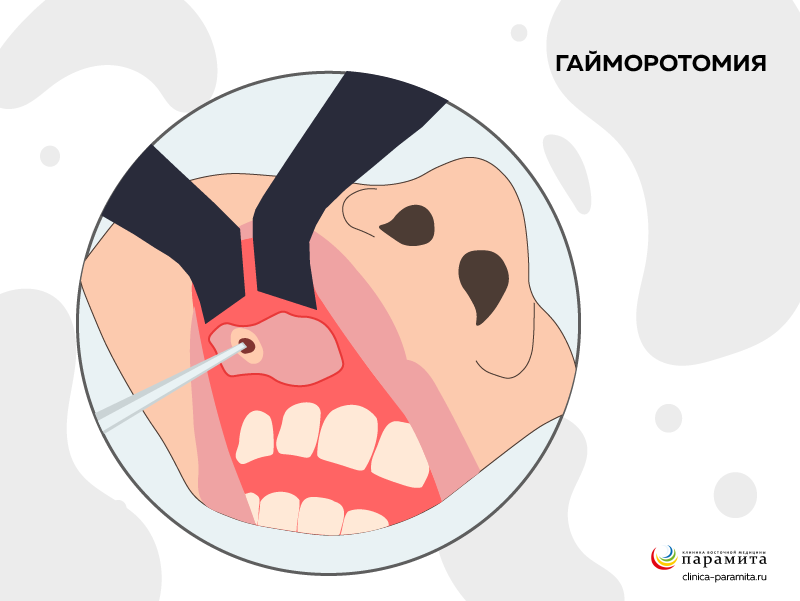 Прокол верхнечелюстной пазухи