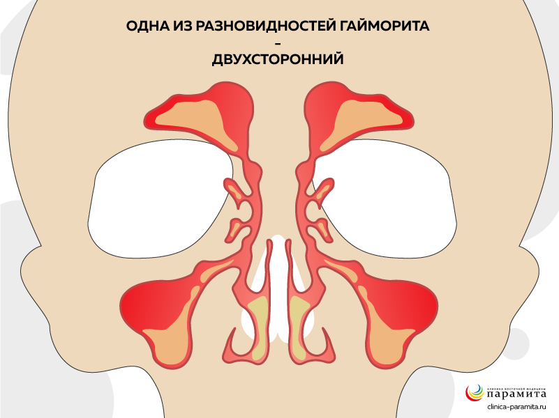 Двусторонний гайморит