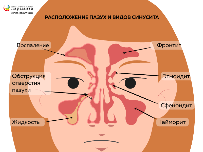 Виды синусита