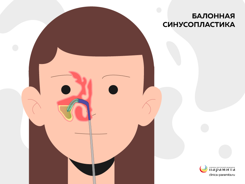 Процедура баллонной синусопластики для лечения гайморита
